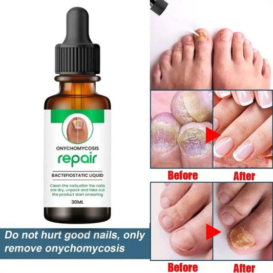 Nail Serum for Nail Growth & Repair and Fungal ( 50% Off )  Click  ( Pack Of 2) Get Extra 30 % Off