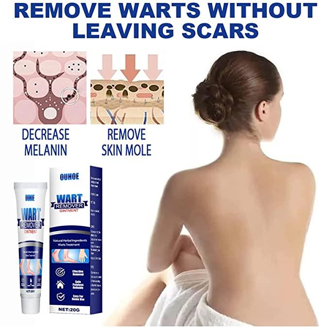 WART REMOVER MASK GEL TUBE ⚡BUY 1 GET 1 FREE⚡